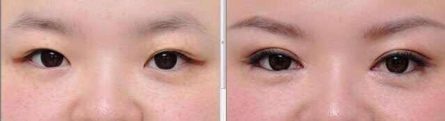 <strong>什么样的双眼皮需要考虑做修复呢?有哪些注意事项?</strong>