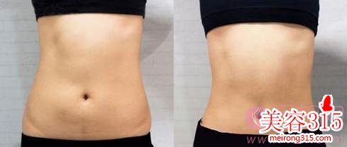 北京八大处李发成腰腹吸脂多少钱?怎么样?