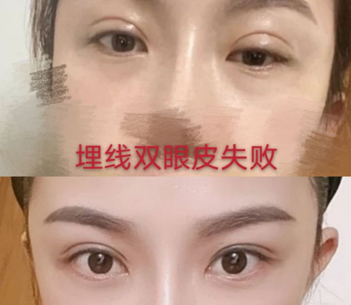 <strong>双眼皮修复难度大吗?</strong>