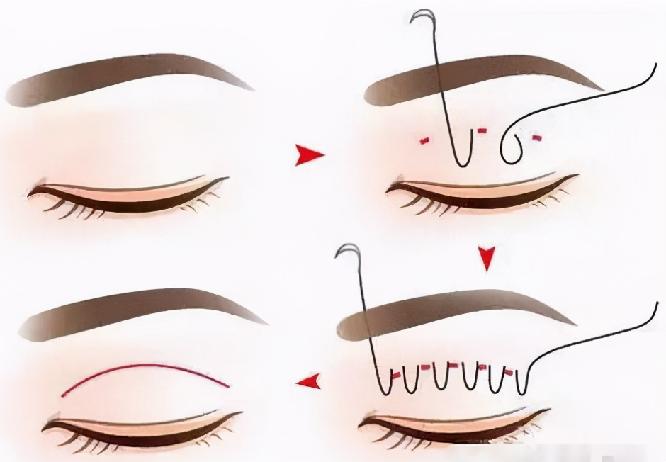 怎么样双眼皮才算失败你清楚吗?