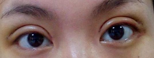 怎么样双眼皮才算失败你清楚吗?