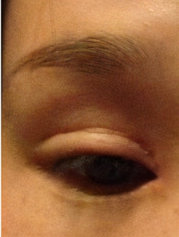 怎么样双眼皮才算失败你清楚吗?