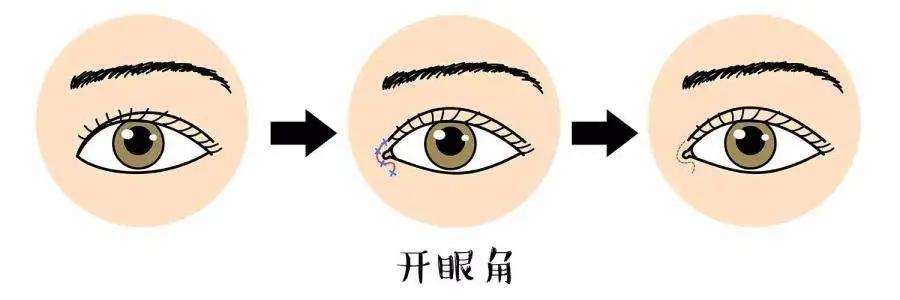为什么割双眼皮还得配套开个眼角吗?