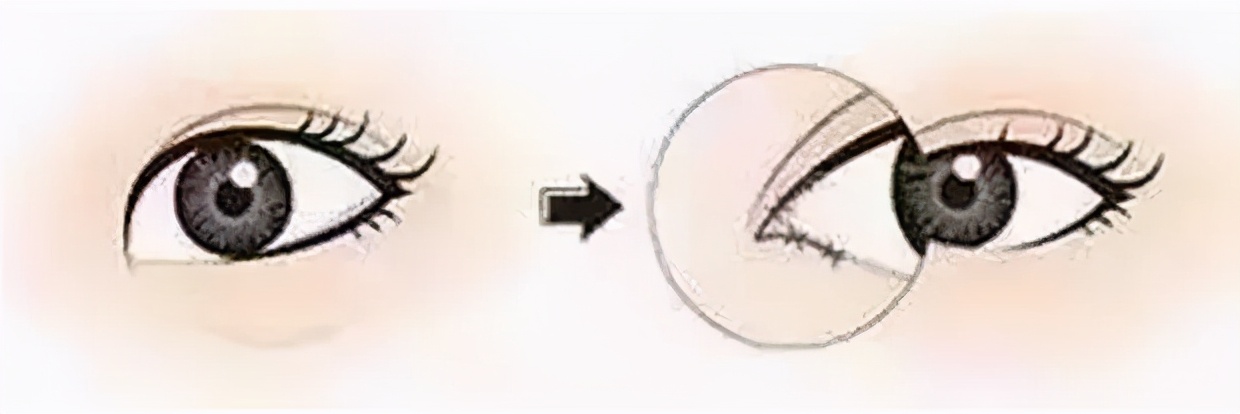 为什么割双眼皮还得配套开个眼角吗?