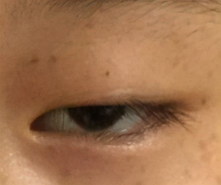 怎么样双眼皮才算失败你清楚吗?