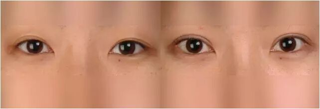 什么样的双眼皮需要考虑做修复呢?有哪些注意事项?