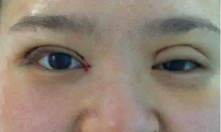 双眼皮做出了错误的选择,眼睛变成这样