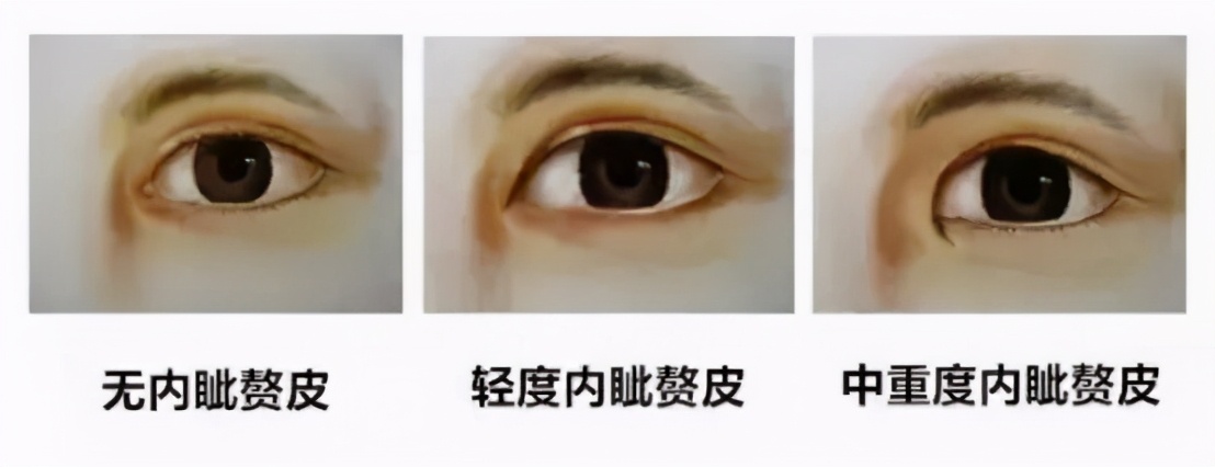 为什么割双眼皮还得配套开个眼角吗?