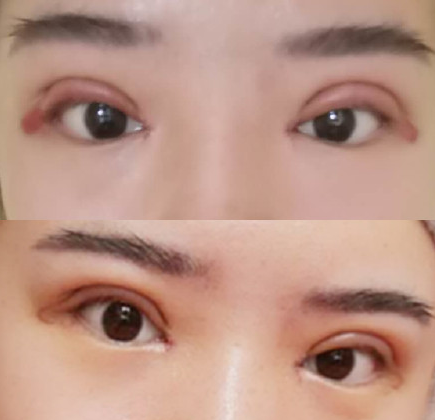 <strong>不想眼修复?关于双眼皮没做好的相关问题你得了解一下</strong>