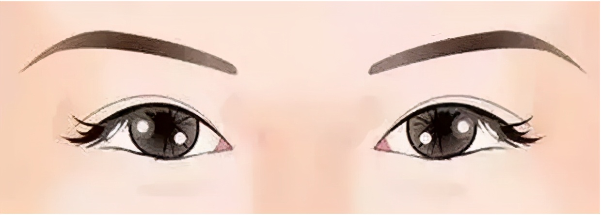 为什么割双眼皮还得配套开个眼角吗?