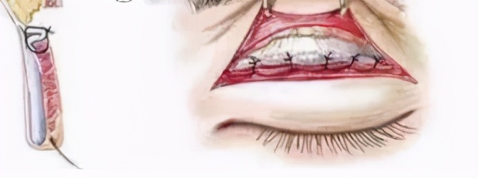 怎么样双眼皮才算失败你清楚吗?