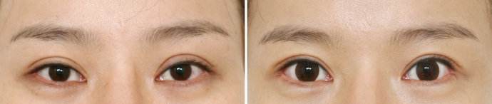 什么样的双眼皮需要考虑做修复呢?有哪些注意事项?