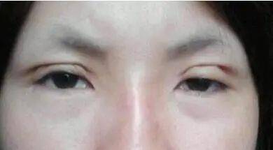 双眼皮做出了错误的选择,眼睛变成这样