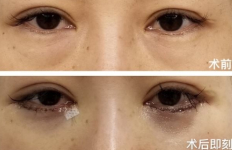 大神来谈谈切除眼袋手术术后多久恢复 大神来谈谈切除眼袋手术术后多久恢复