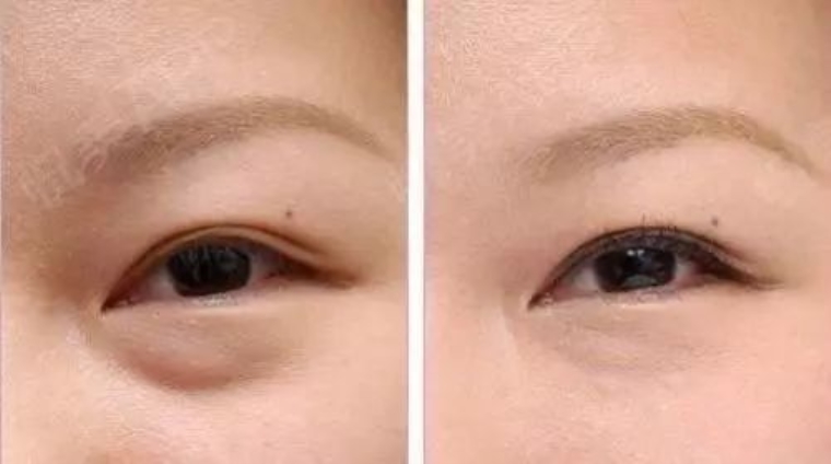 大神来谈谈切除眼袋手术术后多久恢复 大神来谈谈切除眼袋手术术后多久恢复