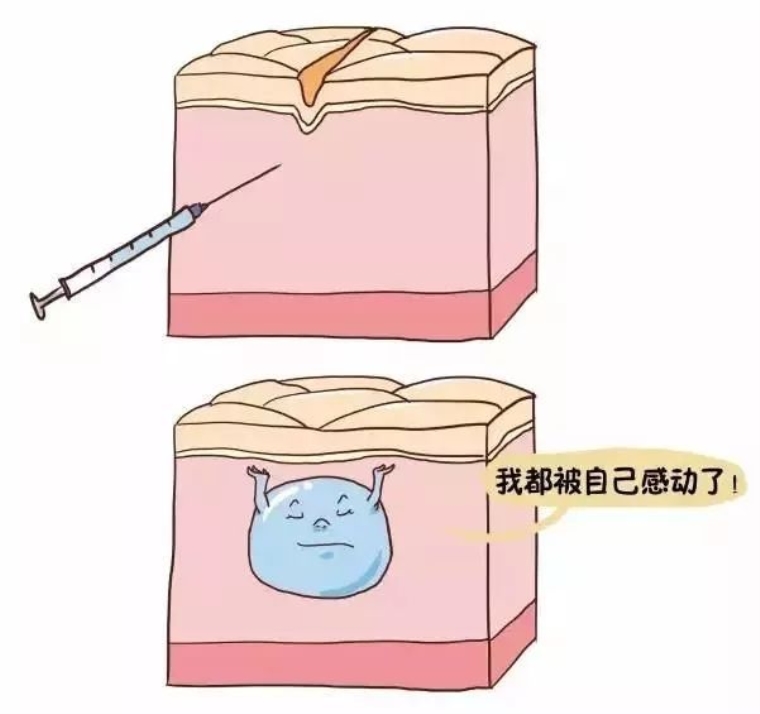 老司机给你说玻尿酸注射丰臀的效果怎么样 老司机给你说玻尿酸注射丰臀的效果怎么样