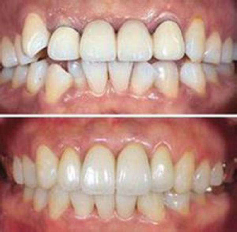 编辑来谈谈导致牙齿拥挤的原因 编辑来谈谈导致牙齿拥挤的原因