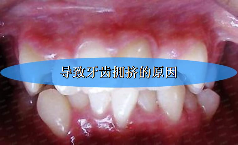 编辑来谈谈导致牙齿拥挤的原因 编辑来谈谈导致牙齿拥挤的原因