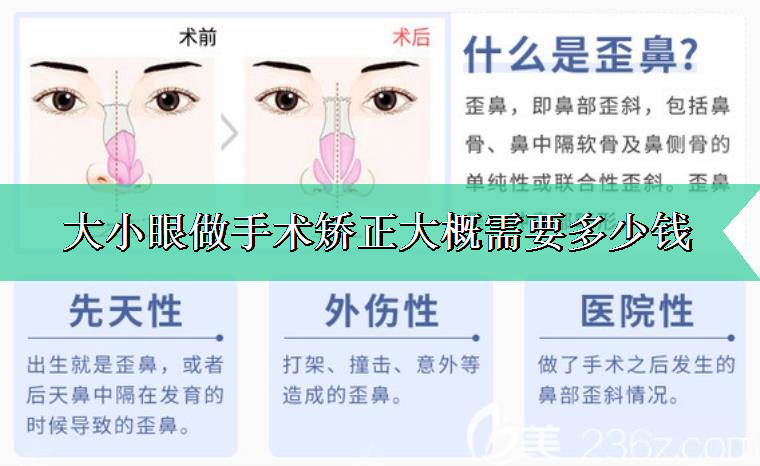 关于聊聊大小眼做手术矫正大概需要多少钱 关于聊聊大小眼做手术矫正大概需要多少钱