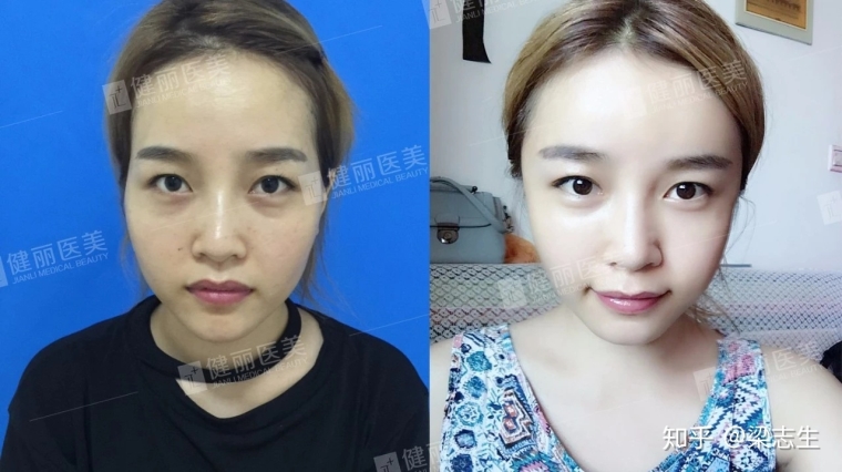 桃子姐聊聊天津玻尿酸填充能保持多久 桃子姐聊聊天津玻尿酸填充能保持多久