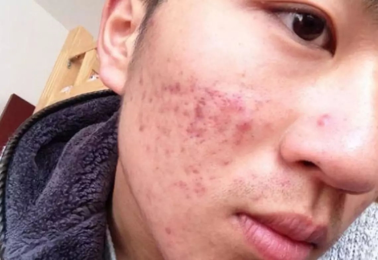 过来人今天说说昆明怎样去除额头皱纹 过来人今天说说昆明怎样去除额头皱纹