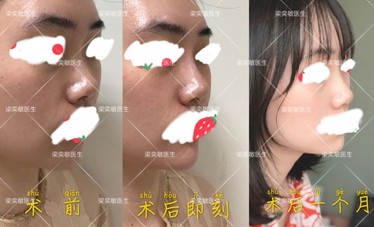 爱美人士聊假体垫下巴材料有哪些 爱美人士聊假体垫下巴材料有哪些