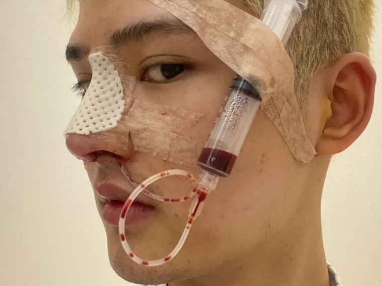 高手解答苏州做假体隆胸术后要怎么保养 高手解答苏州做假体隆胸术后要怎么保养