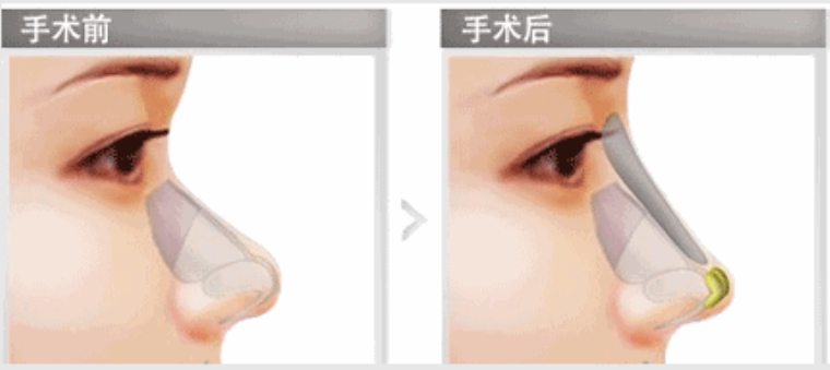 关于解答鼻假体取出后多久恢复 关于解答鼻假体取出后多久恢复