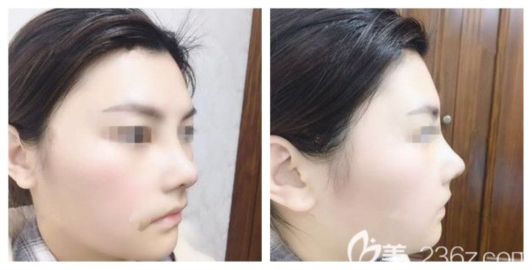 关于解答鼻假体取出后多久恢复 关于解答鼻假体取出后多久恢复