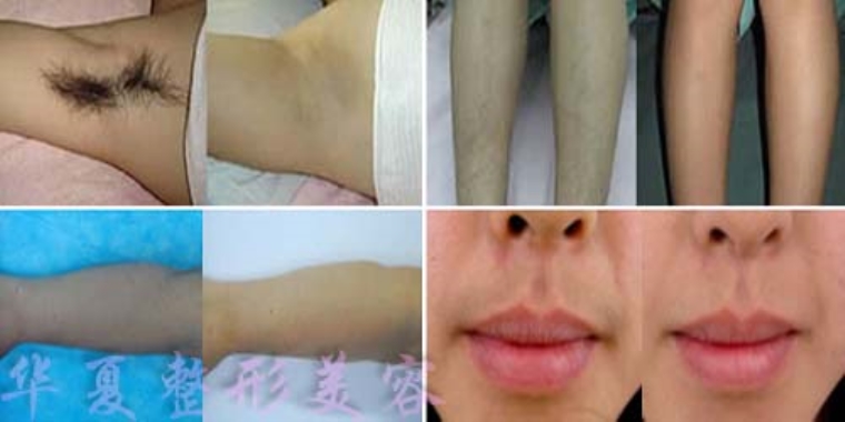 谈一谈什么方法能够永久脱毛 谈一谈什么方法能够永久脱毛