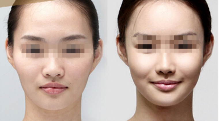 踩过坑的告诉你苹果肌注射玻尿酸有没有后遗症 踩过坑的告诉你苹果肌注射玻尿酸有没有后遗症