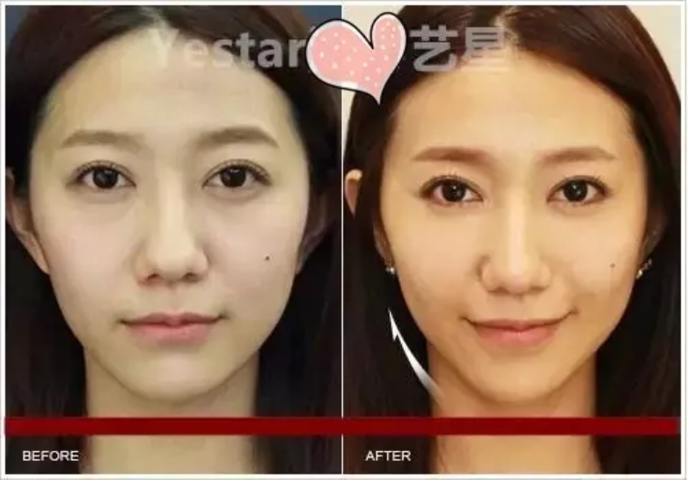 踩过坑的告诉你苹果肌注射玻尿酸有没有后遗症 踩过坑的告诉你苹果肌注射玻尿酸有没有后遗症