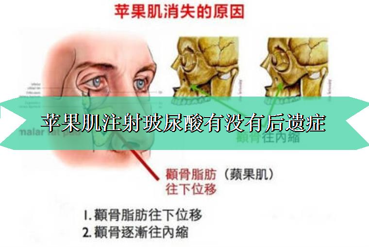 踩过坑的告诉你苹果肌注射玻尿酸有没有后遗症 踩过坑的告诉你苹果肌注射玻尿酸有没有后遗症