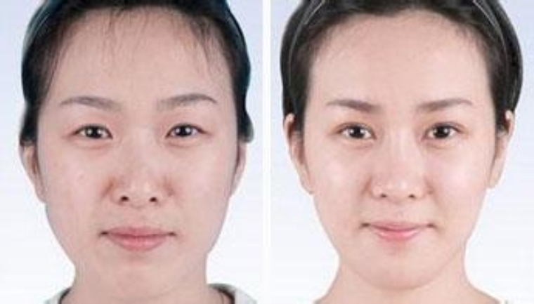 踩过坑的告诉你苹果肌注射玻尿酸有没有后遗症 踩过坑的告诉你苹果肌注射玻尿酸有没有后遗症