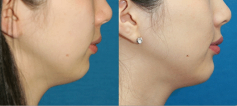 过来人今天说说自体脂肪丰下巴的适合人群 过来人今天说说自体脂肪丰下巴的适合人群