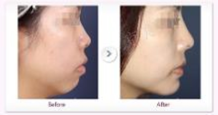 过来人今天说说自体脂肪丰下巴的适合人群 过来人今天说说自体脂肪丰下巴的适合人群