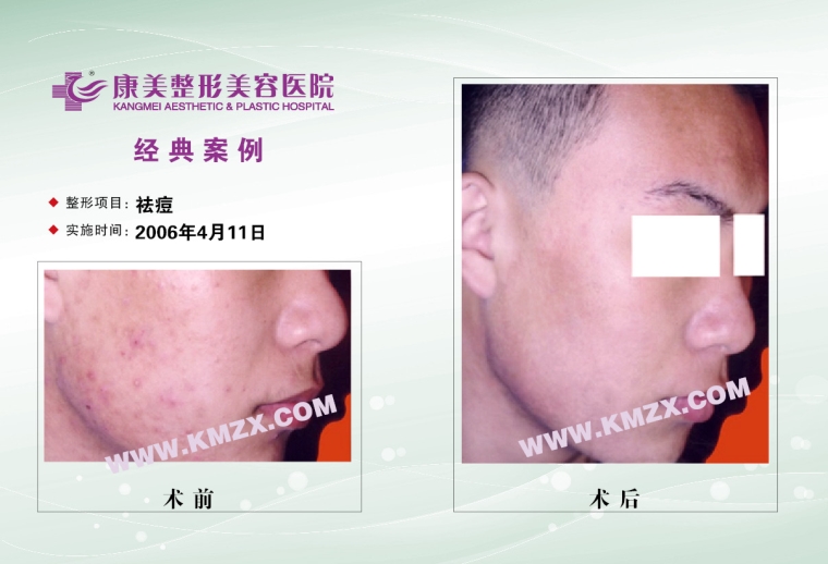 咱们来谈谈昆明激光祛痘一般多少钱 咱们来谈谈昆明激光祛痘一般多少钱