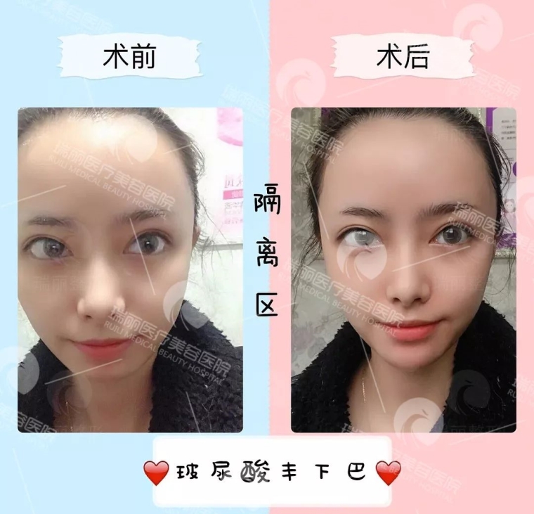 大神解答长沙激光除皱多少钱 大神解答长沙激光除皱多少钱