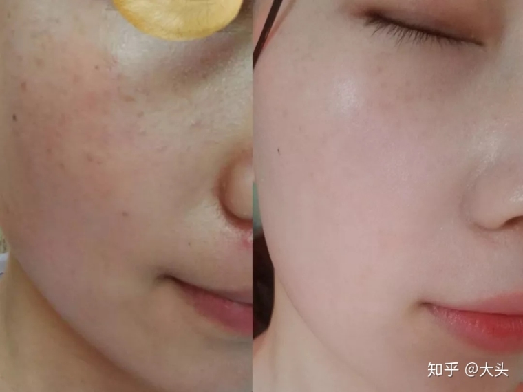老司机谈谈南京祛斑的方法有哪些 老司机谈谈南京祛斑的方法有哪些