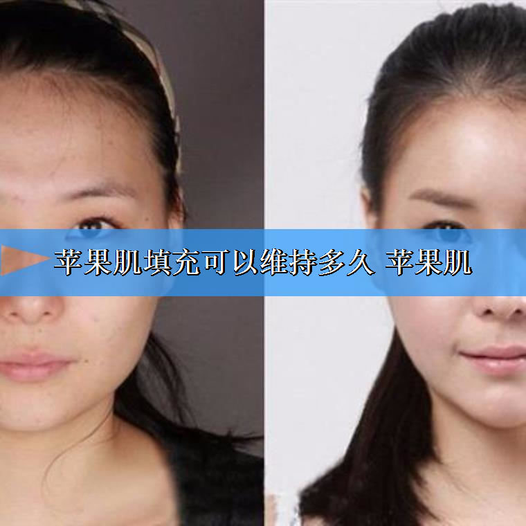今日来详解苹果肌填充可以维持多久 苹果肌填充 今日来详解苹果肌填充可以维持多久 苹果肌填充