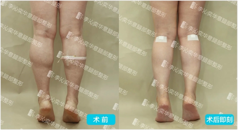 今日来聊聊腿部吸脂的价格,你想知道的全在这! 今日来聊聊腿部吸脂的价格,你想知道的全在这!