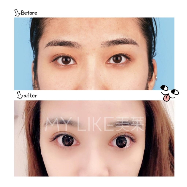 笔者说说上海去眼袋手术后多久见效 笔者说说上海去眼袋手术后多久见效