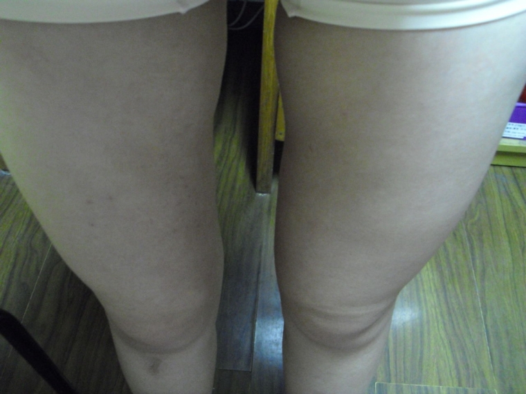 经验人士来谈谈腿部吸脂价格是多少 经验人士来谈谈腿部吸脂价格是多少