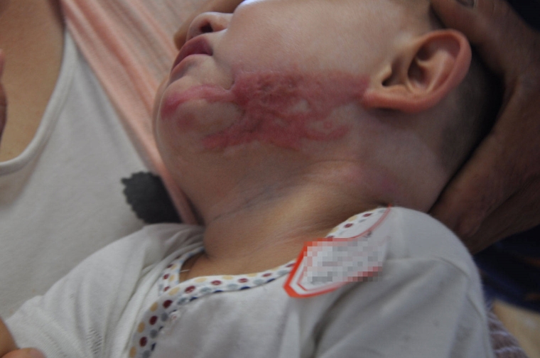 过来人今天说说疤痕体质不能做整形项目了吗? 过来人今天说说疤痕体质不能做整形项目了吗?