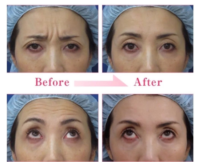 过来人今天说说疤痕体质不能做整形项目了吗? 过来人今天说说疤痕体质不能做整形项目了吗?