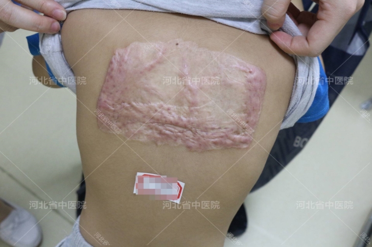 过来人今天说说疤痕体质不能做整形项目了吗? 过来人今天说说疤痕体质不能做整形项目了吗?