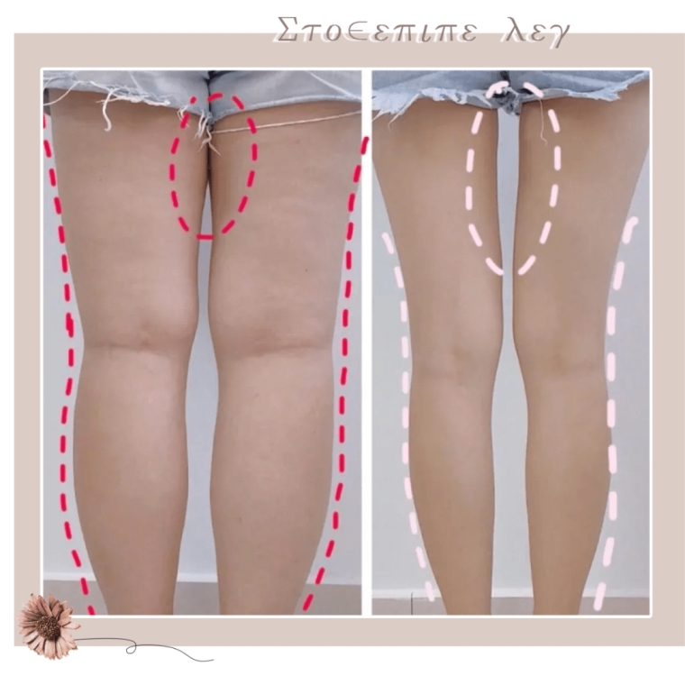 爱美人士谈谈腿部粗有什么方法解决 爱美人士谈谈腿部粗有什么方法解决