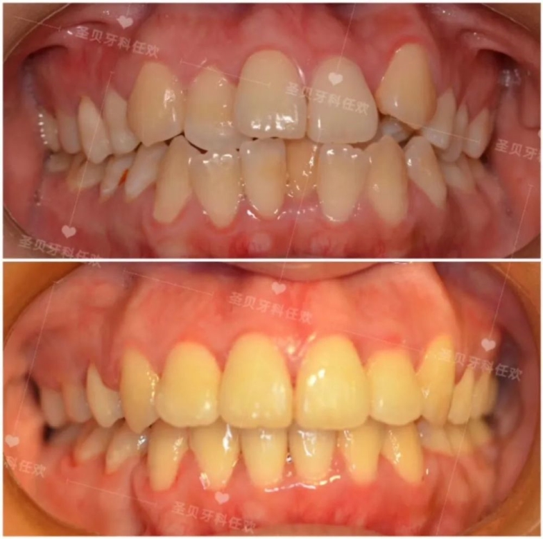 高手详解北京做牙齿正畸术后会反弹吗 高手详解北京做牙齿正畸术后会反弹吗