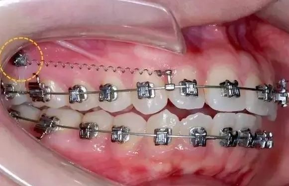 高手详解北京做牙齿正畸术后会反弹吗 高手详解北京做牙齿正畸术后会反弹吗