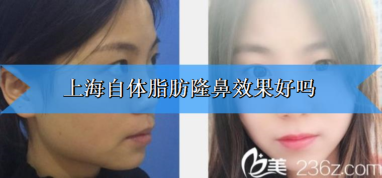 老医生给你说上海自体脂肪隆鼻效果好吗 老医生给你说上海自体脂肪隆鼻效果好吗